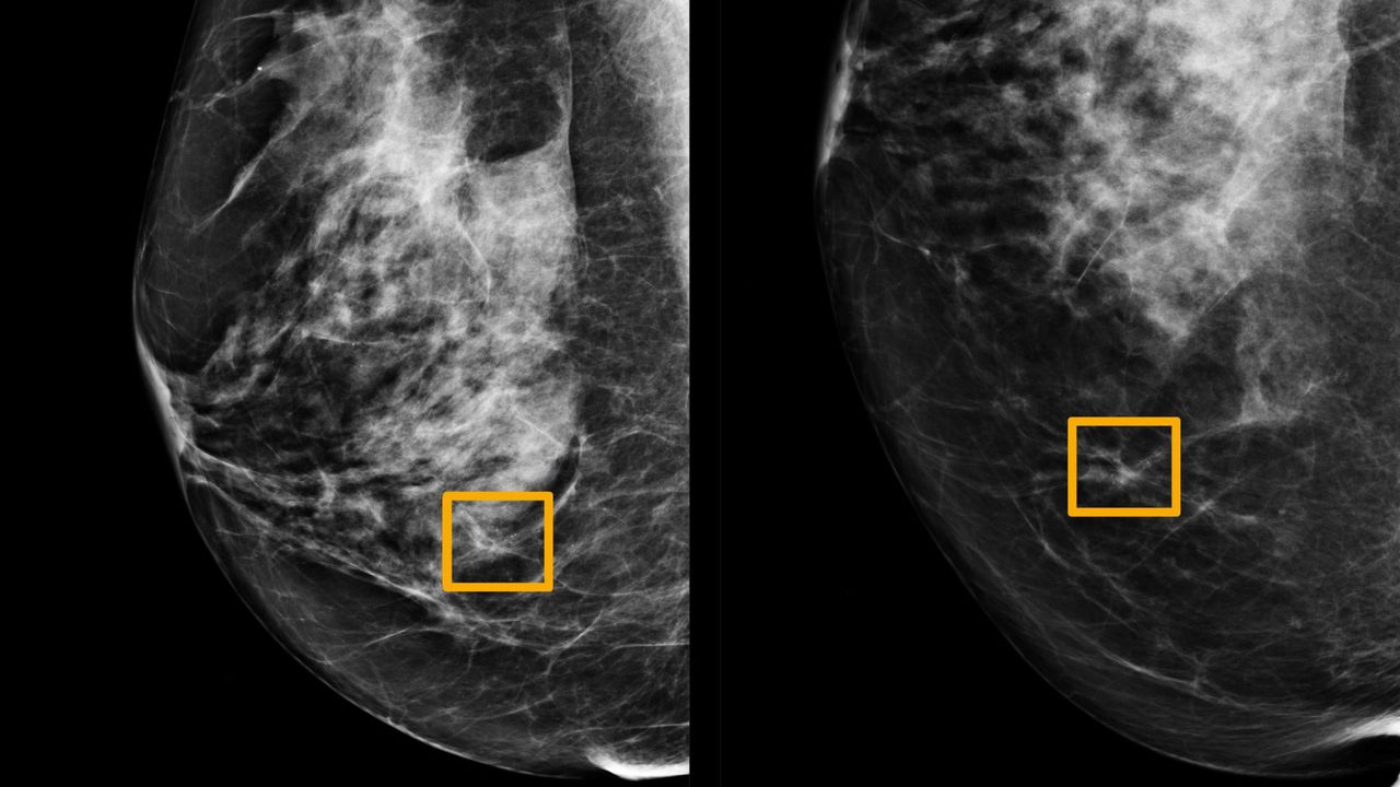 Google's AI trained to diagnose breast cancer from mammograms outperforms doctors. Image via Northwestern University.