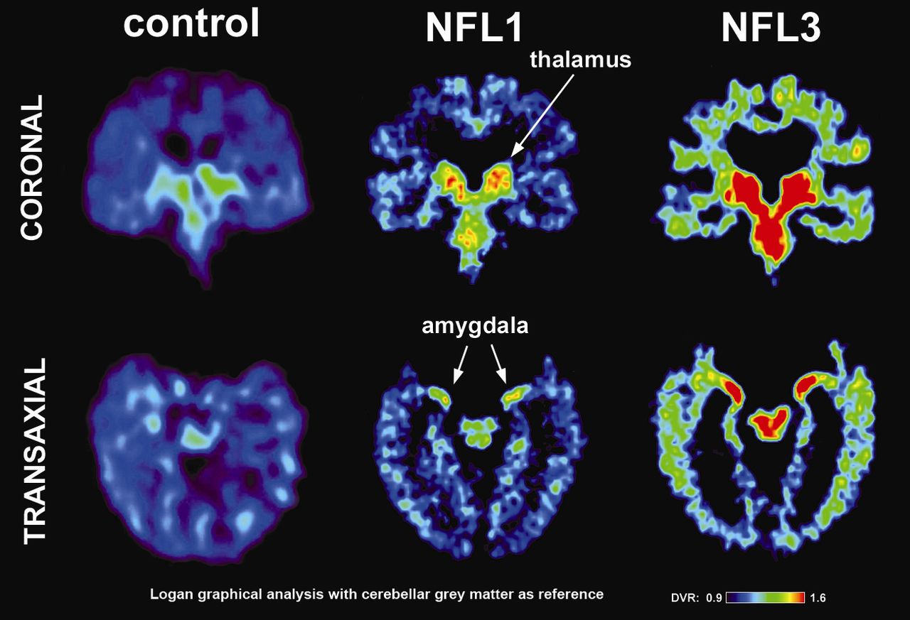 Research finds key protein signals that might signal concussions in college athletes. Image via ITNonline.